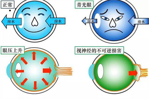青光眼形成原因