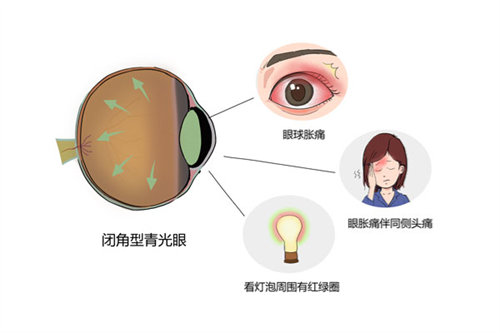青光眼症状