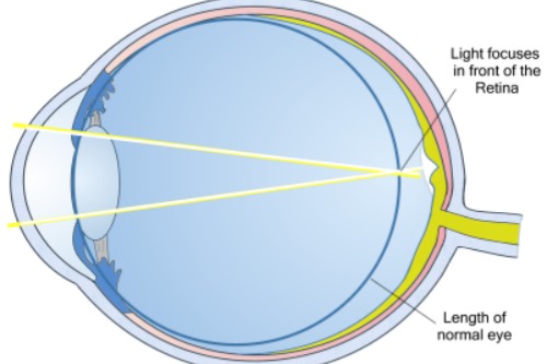 近视眼光线示意图
