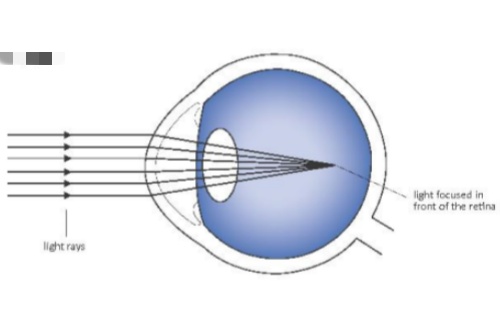 近视眼示意图
