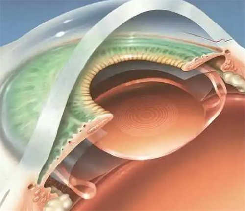 人工晶体植入展示图