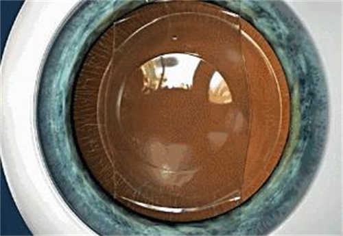 人工晶体植入图