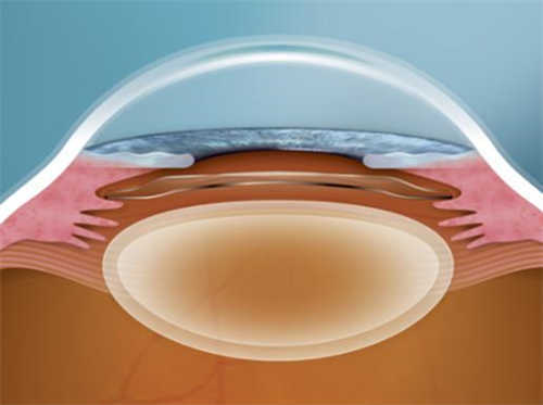 人工晶体植入眼球体示意图