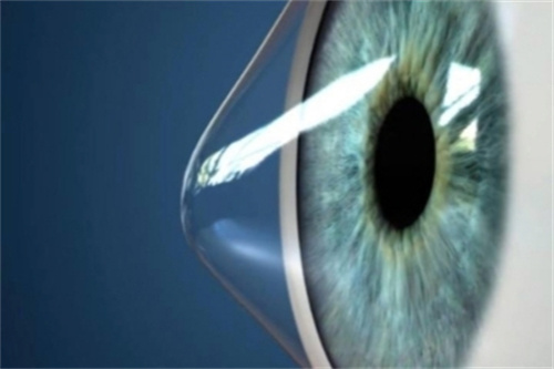 问答：了解圆锥角膜的病因及症状，保护眼睛健康！