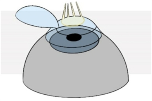 TPRK激光近视手术过程