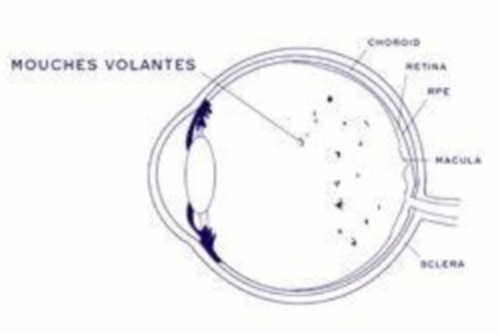 医生解析——飞蚊症激光消融术，了解其手术风险以及后遗症！