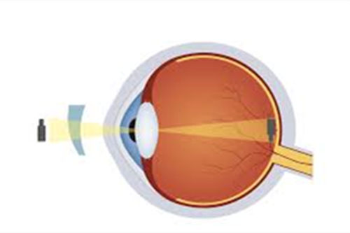 敲黑板：散光度数怎么参考？轻重度散光区别,重度咋治疗？