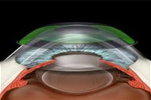 晶体植入示意图