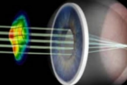 角膜形态示意图 角膜形态示意图