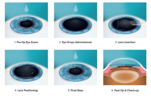 晶体植入术过程示意图 晶体植入术过程示意图