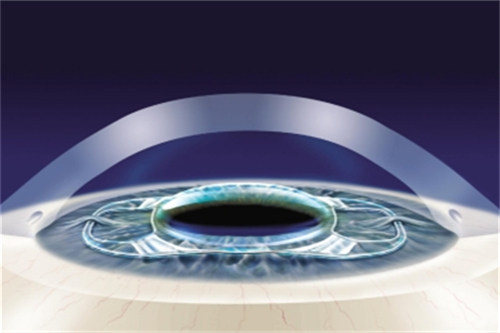 晶体植入手术示图 晶体植入手术示图