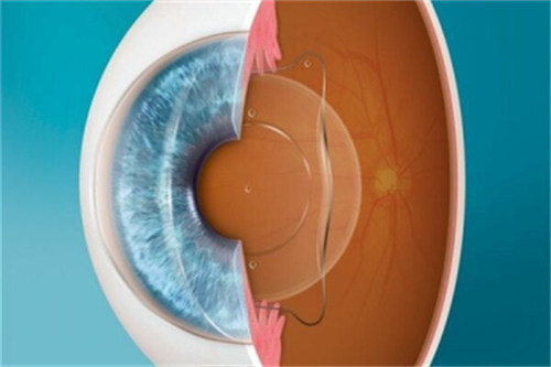 晶体植入手术动画示意图 晶体植入手术动画示意图