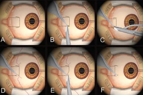 斜视手术 斜视手术
