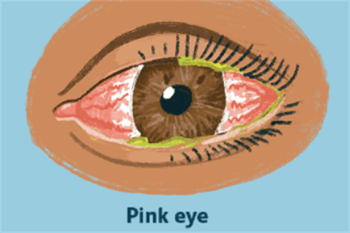 眼睛红肿