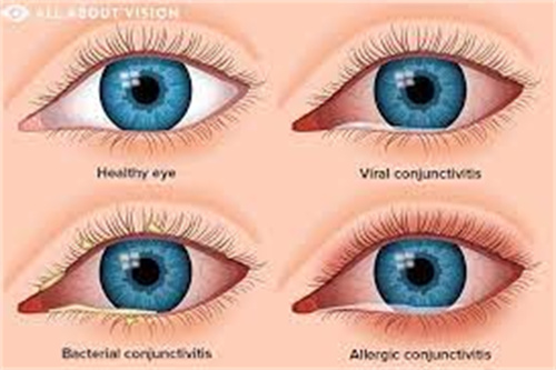 结膜炎 结膜炎