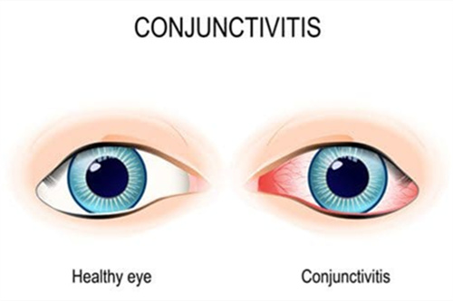 结膜炎的眼睛
