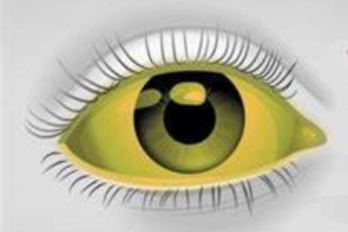 10岁孩子眼睛黄是什么原因引起的？胆红素/肝炎/疾病，快来了解！