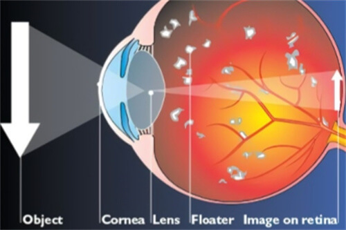飞蚊症眼球结构示意图
