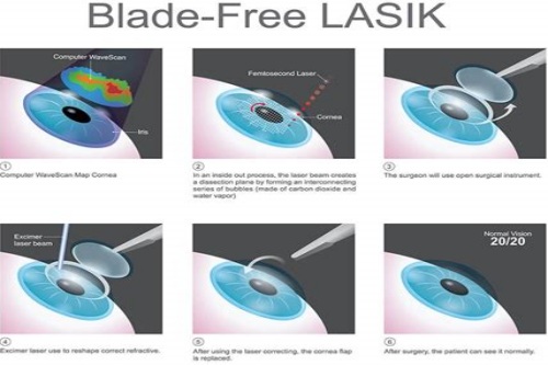 宁波近视手术价格大公开：全激光6800元起/半飞秒1100元起/全飞秒15800元起！