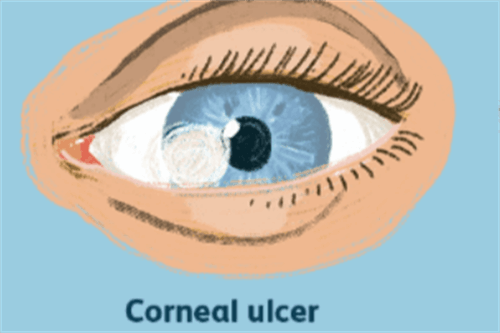 角膜溃疡