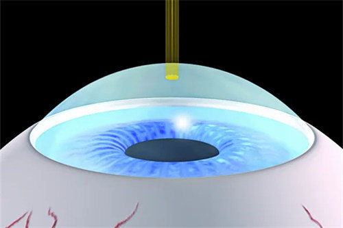 smart手术示意图