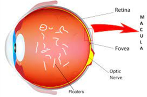 飞蚊症眼底 飞蚊症眼底