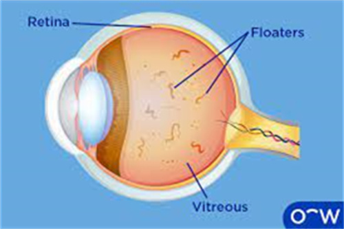 眼睛飞蚊症 眼睛飞蚊症