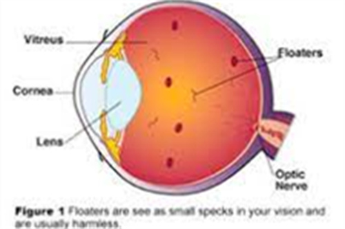 飞蚊症图 飞蚊症图