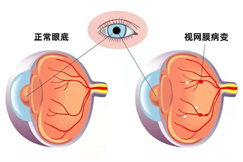 视网膜病变