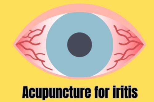 虹膜炎大揭秘：引起的原因、症状以及治疗方法全都有，快来了解！