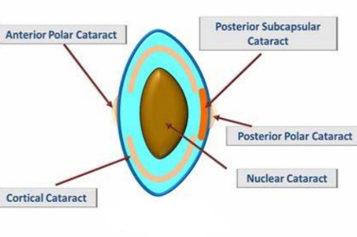 十问十答：年轻人晶体混浊可以恢复吗？一般可以改善，不能完全恢复！