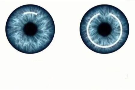 近视手术必看：全飞秒和半飞秒那种好？费用分别是多少