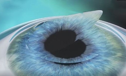 角膜瓣动画示意图 角膜瓣动画示意图