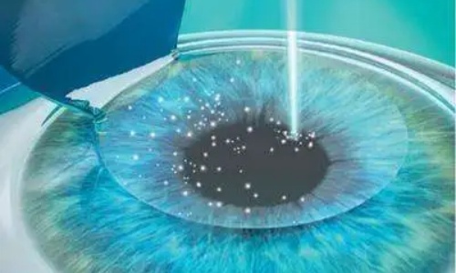 全飞秒手术示意图 全飞秒手术示意图