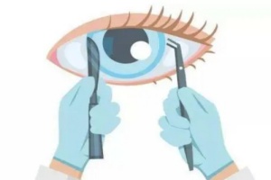 近视眼角膜屈光手术示意图 近视眼角膜屈光手术示意图