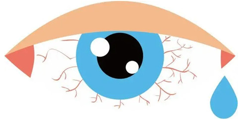 很困扰，泪道阻塞会引起眼干吗？“幕后黑手”是累到阻塞吗？