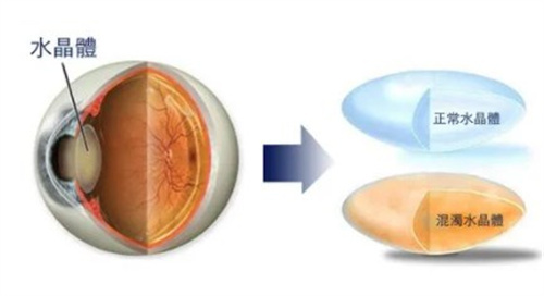 单焦点人工晶体手术后可以开车吗？手术早期不宜夜间开车！