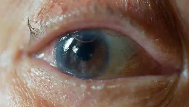 来看看自己是不是容易得白内障的人！如何判断自己是否已经得了白内障？