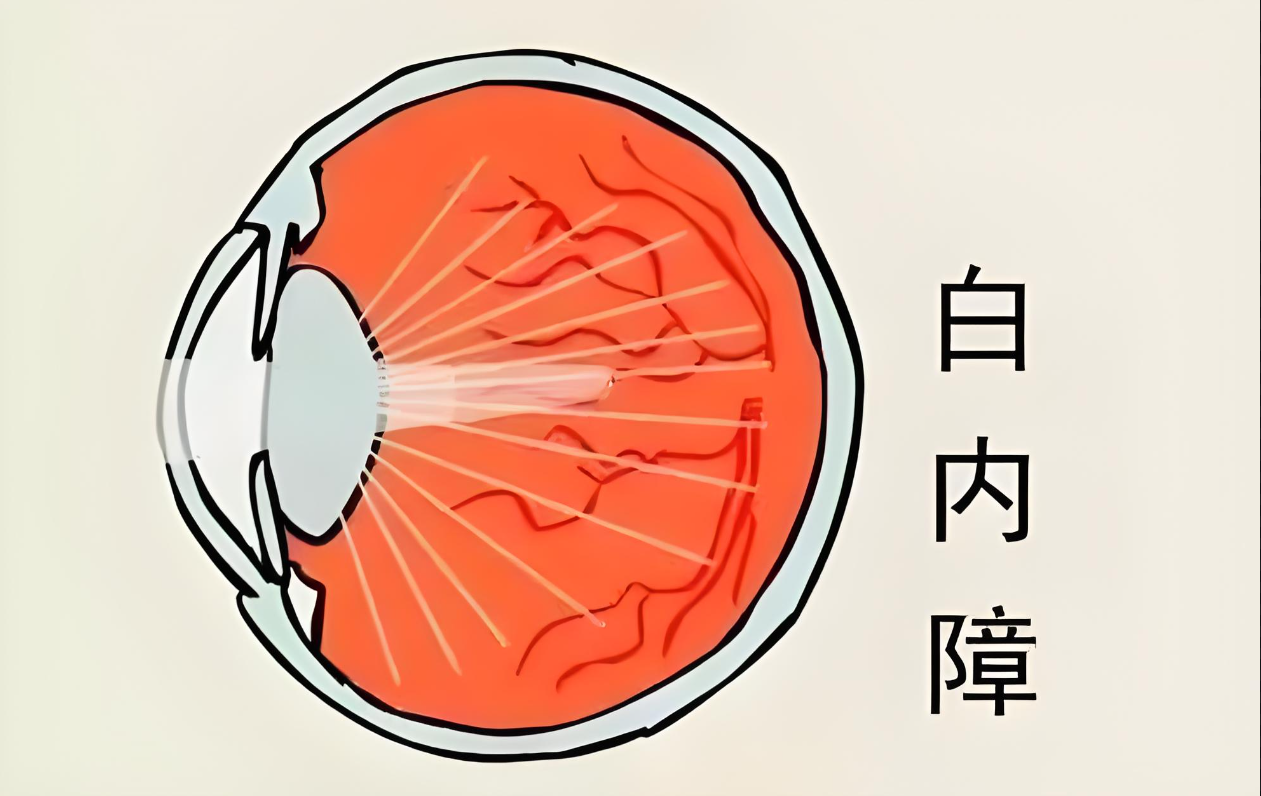 各地区白内障手术的价格一览，做手术需住院的天数，术后要注意的事项