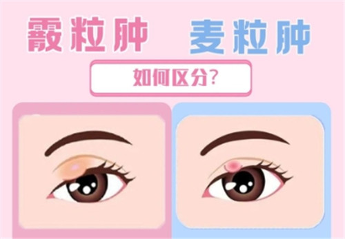 霰粒肿和麦粒肿的区别