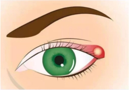 霰粒肿手术多少钱？霰粒肿是什么？霰粒肿手术的优缺点是什么？