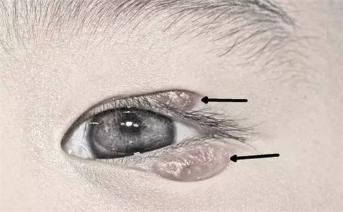 眼部霰粒肿的图片