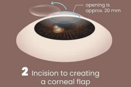 制作角膜上皮瓣 制作角膜上皮瓣