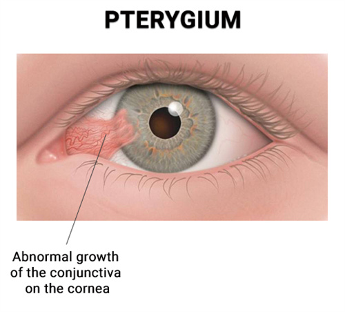 翼状胬肉对眼睛的影响 翼状胬肉对眼睛的影响