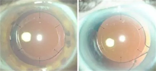 飞秒激光辅助白内障手术的原理、优势、手术过程、术后注意事项、费用和适用人群