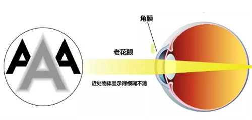老花眼眼球的变化图片 老花眼眼球的变化图片