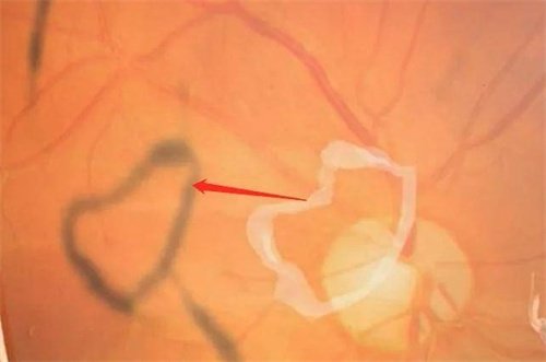 ‌飞蚊症会致盲？这种类型的必须马上治疗‌