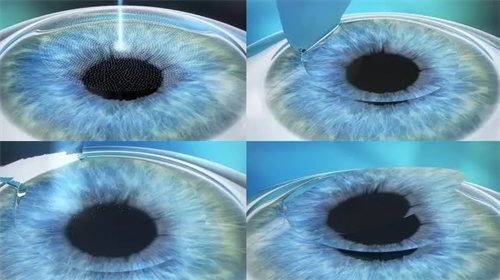 近视矫正眼镜与角膜塑形镜：哪种更适合你？