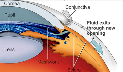 青光眼的7大征兆，快来看看你有这些症状吗？