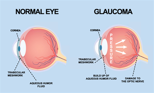 青光眼动画演示图 青光眼动画演示图